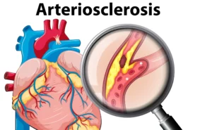 Atherosclerosis: Risk Factors