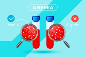 Holistic Approaches: 5 Natural Treatments For Anemia Symptoms