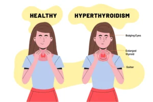 Symptoms, Causes, Diet For Hypothyroidism (Underactive Thyroid)