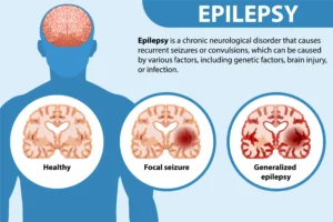 A Comprehensive Guide About Epilepsy