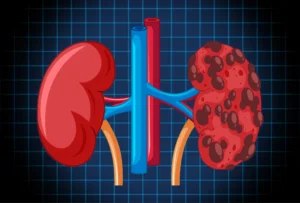 Kidney Failure: Symptoms and Natural Prevention Strategies